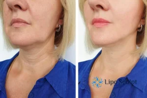 Double chin before and after Hi-Fu treatment 4 Book your double chin treatment Bridgend today! We are here to help!