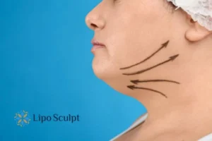 Double chin before and after Hi-Fu treatment 3 Boost your confidence with a Double chin treatment Bridgend