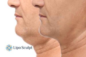 Double chin before and after Hi-Fu treatment 2 Double chin treatment Bridgend from Lipo Sculpt - feel more confident today!