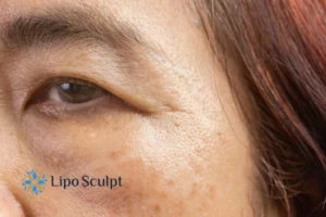 Cryopen: The Revolutionary Treatment for Age Spots Unveiled 2 Are age spots Bridgend giving you low self esteem? Contact us today!