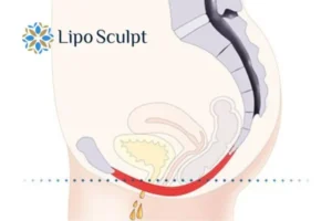 Pelvic Floor Chair Therapy 1 Pelvic Floor Chair Therapy Bridgend to treat incontinence.
