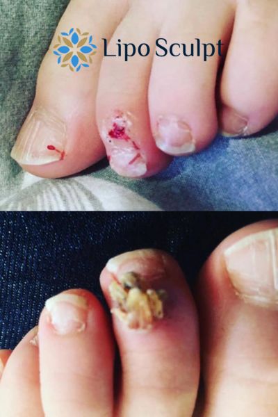 Wart removal customer results from Lipo Sculpt Bridgend